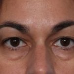 Blepharoplasty Before & After Patient #33829