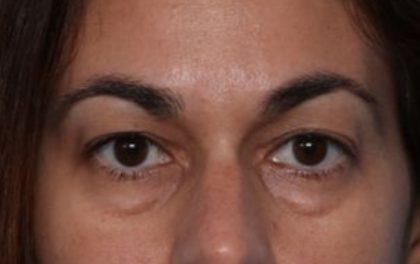 Blepharoplasty Before & After Patient #33829