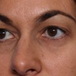 Blepharoplasty Before & After Patient #33829