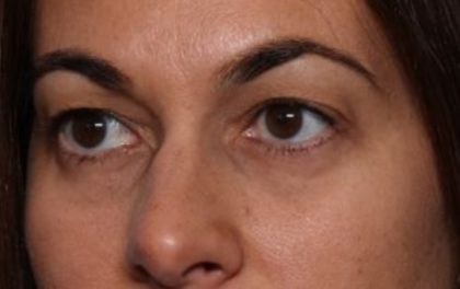 Blepharoplasty Before & After Patient #33829