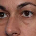 Blepharoplasty Before & After Patient #33829