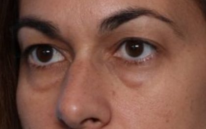 Blepharoplasty Before & After Patient #33829