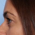 Blepharoplasty Before & After Patient #33829