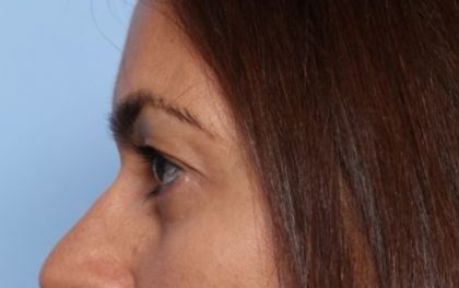 Blepharoplasty Before & After Patient #33829