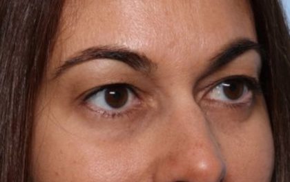 Blepharoplasty Before & After Patient #33829