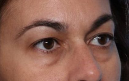 Blepharoplasty Before & After Patient #33829