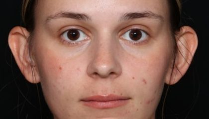 Otoplasty Before & After Patient #33723