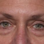 Blepharoplasty Before & After Patient #33951