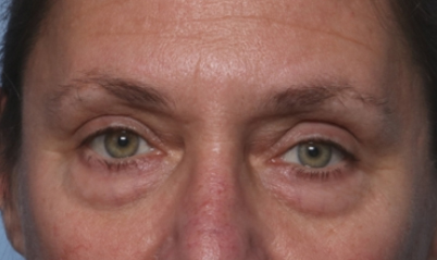 Blepharoplasty Before & After Patient #33951