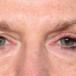 Blepharoplasty Before & After Patient #33917