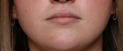 Lip Filler Before & After Patient #33952