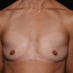 Breast Augmentation Before & After Patient #33959