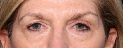 Blepharoplasty Before & After Patient #33917