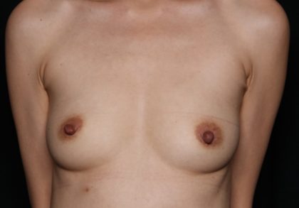 Breast Augmentation Before & After Patient #34007
