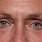 Blepharoplasty Before & After Patient #33951