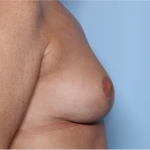 Breast Lift Before & After Patient #34048