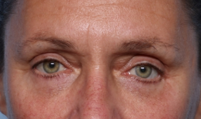 Blepharoplasty Before & After Patient #33951