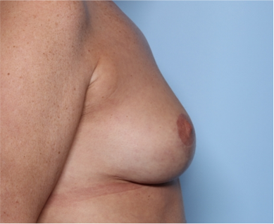 Breast Lift Before & After Patient #34048