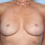 Breast Lift Before & After Patient #34090