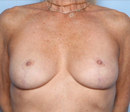 Breast Lift Before & After Patient #34090