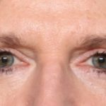 Blepharoplasty Before & After Patient #33917