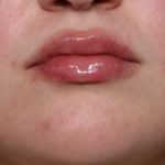 Lip Filler Before & After Patient #33952