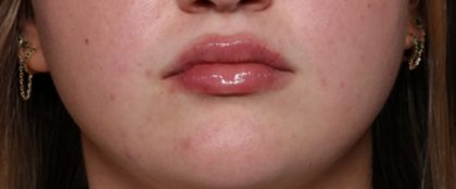 Lip Filler Before & After Patient #33952