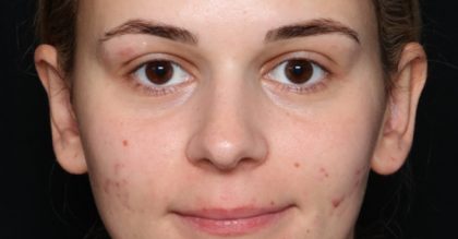 Otoplasty Before & After Patient #33970