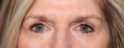 Blepharoplasty Before & After Patient #33917