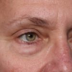Blepharoplasty Before & After Patient #33951