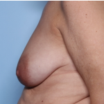 Breast Lift Before & After Patient #34048