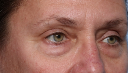 Blepharoplasty Before & After Patient #33951