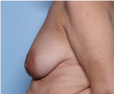 Breast Lift Before & After Patient #34048