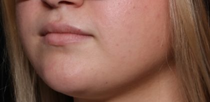 Lip Filler Before & After Patient #33952