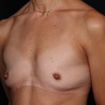 Breast Augmentation Before & After Patient #33959