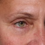 Blepharoplasty Before & After Patient #33951