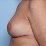 Breast Lift Before & After Patient #34048