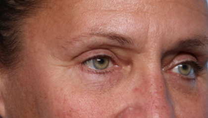 Blepharoplasty Before & After Patient #33951