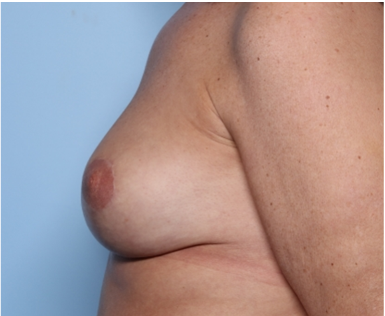 Breast Lift Before & After Patient #34048