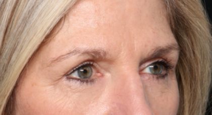 Blepharoplasty Before & After Patient #33917