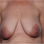 Breast Lift Before & After Patient #34048