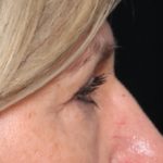 Blepharoplasty Before & After Patient #33917