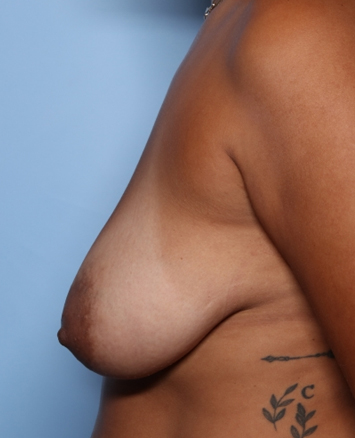 Breast Lift with Implant Before & After Patient #33984