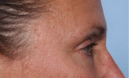 Blepharoplasty Before & After Patient #33951