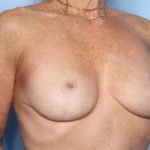 Breast Lift Before & After Patient #34090