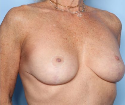 Breast Lift Before & After Patient #34090
