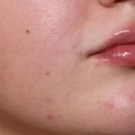 Lip Filler Before & After Patient #33952