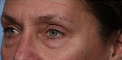 Blepharoplasty Before & After Patient #33951