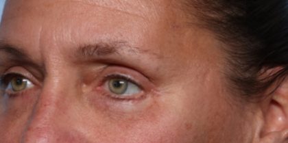 Blepharoplasty Before & After Patient #33951