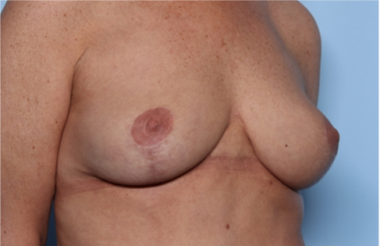 Breast Lift Before & After Patient #34048